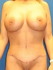 Mommy Makeover Before & After