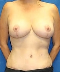 Mommy Makeover Before & After