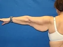 Arm Lift Before & After