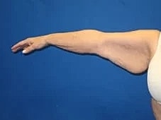 Arm Lift Before & After