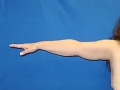 Arm Lift Before & After