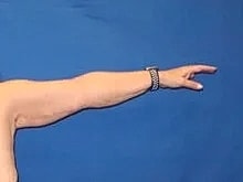 Arm Lift Before & After